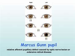 Image result for Marcus Gunn Pupil