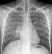 Image result for Miliary Tuberculosis Chest X-ray