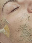 Image result for Green Peel for Acne Scar Treatment