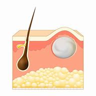 Image result for Sebaceous Cyst Drawing