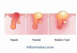 Image result for Pustule Pimple