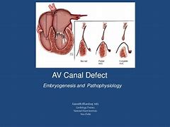 Image result for AV Canal Defect Down Syndrome