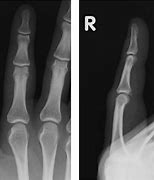 Image result for Volar Fracture