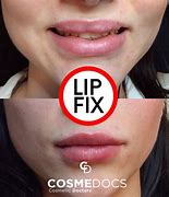 Image result for Bad Lip Fillers