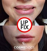 Image result for Worst Lip Fillers