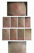 Image result for Deep Acne Cyst