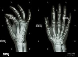 Image result for Normal Hand Radiograph