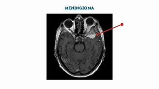 Image result for Meningioma CT Head