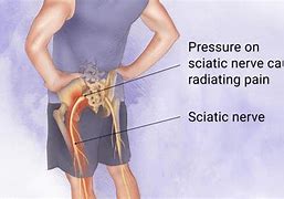 Image result for L3 L4 Sciatica