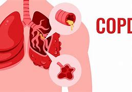 Image result for COPD 3D