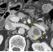 Image result for Pheochromocytoma CT Abdomen