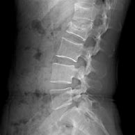 Image result for Lumbar Spine Side View