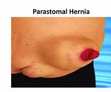 Image result for Colostomy Hernia