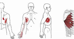 Image result for Serratus Anterior Referred Pain