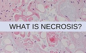 Image result for Avascular Necrosis Pathology