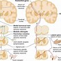 Image result for Cerebral Ataxia