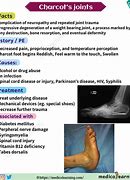 Image result for Charcot Bone Disease