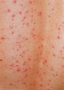 Image result for Psoriasis Bumps On Skin