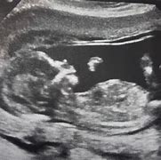 Image result for 13 Week Baby Ultrasound