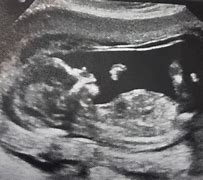 Image result for 13 Week Baby