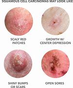 Image result for Squamous and Basal Cell Cancer