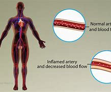 Image result for Vasculitis Signs