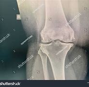 Image result for Patellofemoral Joint Space Narrowing