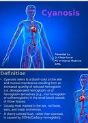 Image result for Cyanosis in Adults