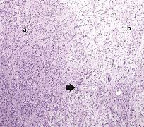 Image result for Vestibular Schwannoma Gross Pathology