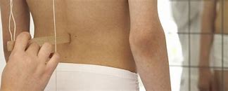 Image result for Plumb Line Scoliosis