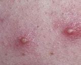 Image result for Pustule Rashes