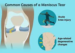 Image result for Tear of Meniscus