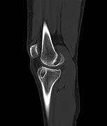 Image result for CT Knee Radiopaedia