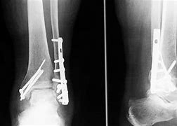 Image result for Left Lateral Malleolus Fracture