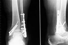 Image result for Lateral Malleolus Fracture Splint