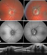 Image result for Enlarged Optic Nerve