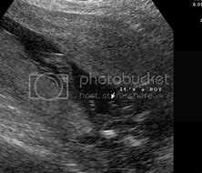 Image result for Baby Girl or Baby Boy Ultrasounds