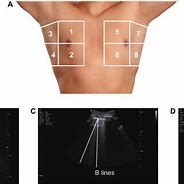 Image result for Lung Ultrasound Probe