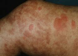 Image result for Vasculitis Signs