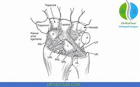 Image result for Volar Wrist Cyst