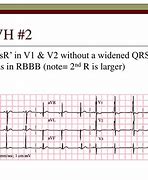 Image result for RVH ECG