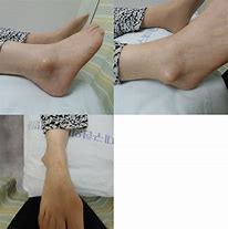 Image result for Right Lateral Malleolus