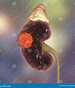 Image result for Kidney Cancer Tumor