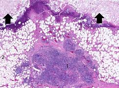 Image result for Necrosis Histology