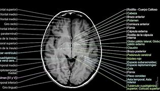 Image result for IRM Cerebral