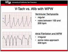 Image result for AFib vs V-fib