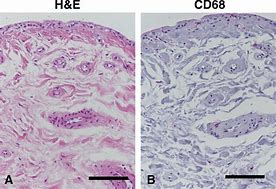 Image result for Inflammed Synovial Tissue