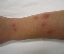 Image result for Different Bug Bites