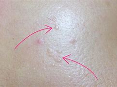 Image result for Benign Skin Bumps