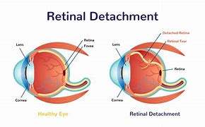 Image result for Damaged Retina